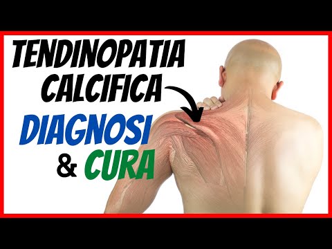 Su cosa donare il sangue se le articolazioni fanno male Ginocchio algodistrofia