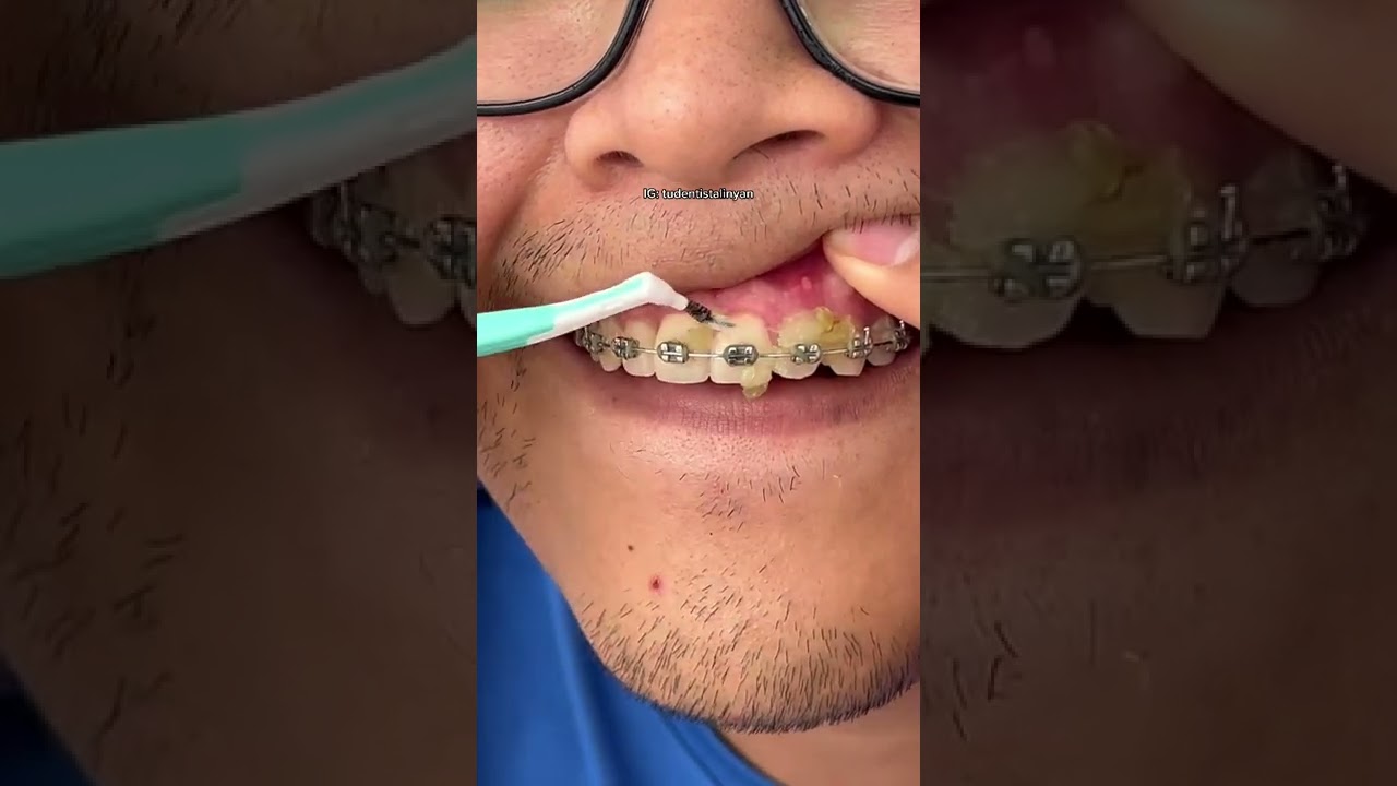 MuelinFlash #31: ¿Qué es EL CEPILLO INTERPROXIMAL 🦷👨🏻‍⚕️🎤