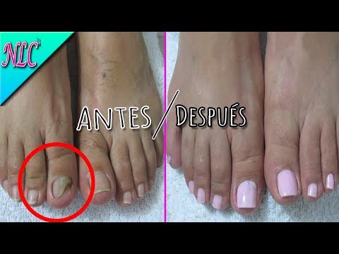 El hongo inveterado de las uñas los medios públicos Los ungüentos del hongo de los pie el nombre