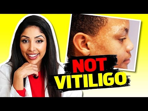 Pityriasis Versicolor Vs Vitiligo | How to Tell The Difference