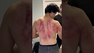 Download lagu Holy Smokes 😳 Cracks & Insane Gua Treatment! #shorts #chiropractor mp3
