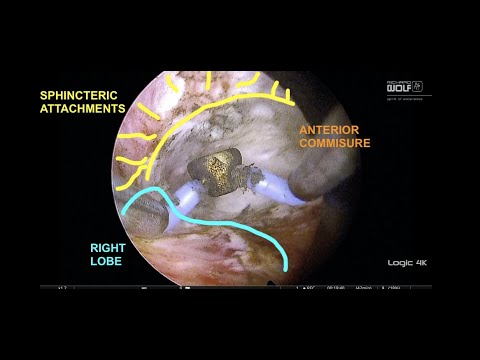 STEP 4 RELEASE OF THE SPHINCTER