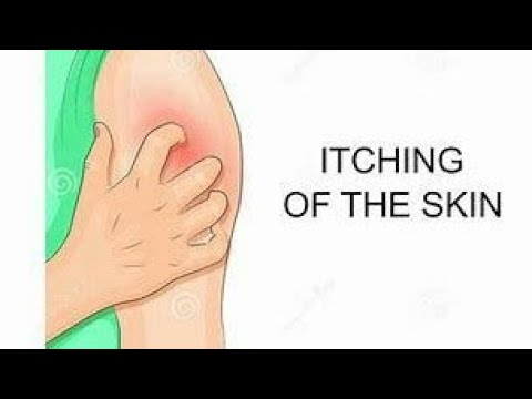 Eczema in un sogno a che Novità da psoriasi un forum