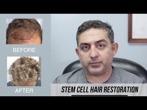 Stem Cell Hair Restoration (Success Story)