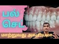 பல் செட் மாற்றுவது அவசியமா complete dentures dr arunkumar pearls dentistry dentist chennai