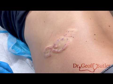Removal of a cluster of lipomas