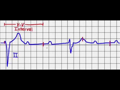 Cardiac Pacing (Failure to Capture/Failure to Sense)