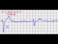 Cardiac Pacing (Failure to Capture/Failure to Sense)