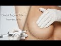 Breast Augmentation New Implants