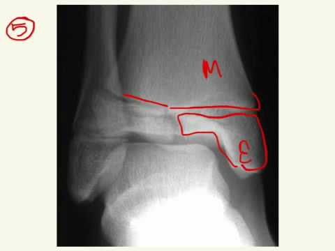 Salter-Harris Fractures Answers