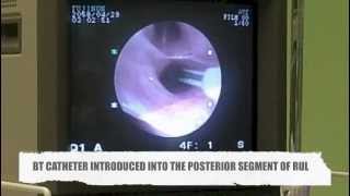preview picture of video 'Bronchial Thermoplasty in Serdang Hospital, Malaysia'