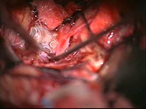 AComA: Clipping of AcomA coiled aneurysm