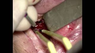 TONES Surgery – Cauterization (Graphic)