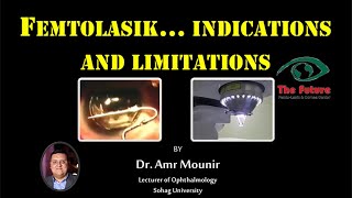 Femtolasik......Indications and Limitations
