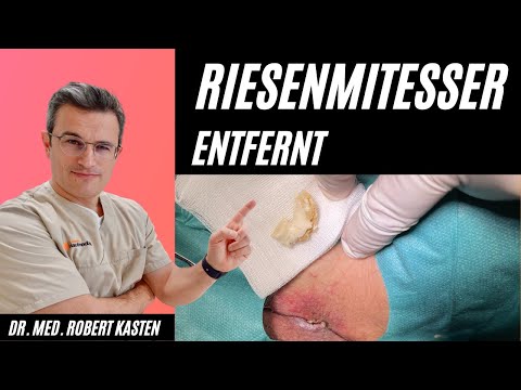 GIANT COMEDO removed from groin: Dermatologist can hardly believe it. Blackhead #pimple giant com...