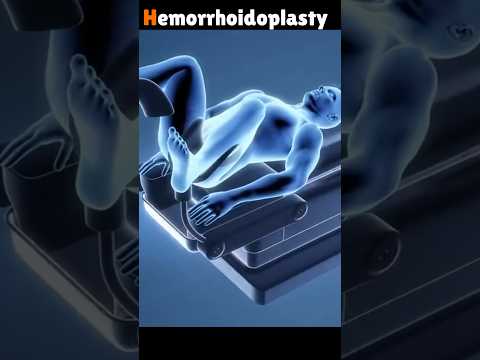 3D Animation of Hemorrhoidoplasty Procedure. #shorts