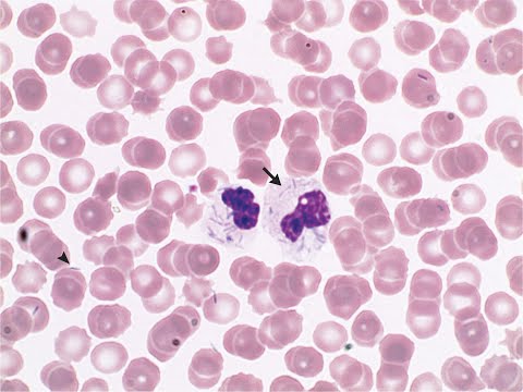 Infektion mit Capnocytophaga canimorsus nach Hundebissverletzung