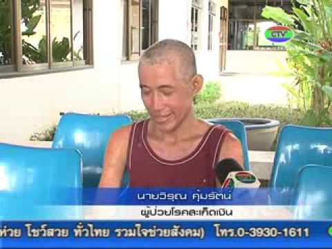 ครีมสำหรับโรคสะเก็ดเงินวันคืน riye wanfuning 15g + 15g ความคิดเห็น โรคสะเก็ดเงินโรคด่างขาวผมร่วง