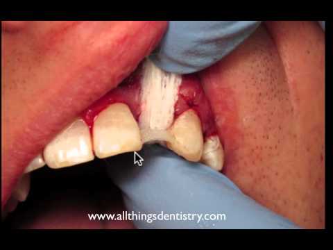 Temporary Bridge using Denture Tooth and Ribbond