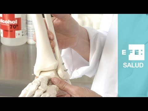 ¿Cómo se soluciona una fractura de peroné?