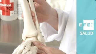 ¿Cómo se soluciona una fractura de peroné