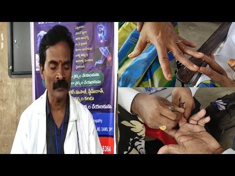 Kerala Acupuncture Pain Relief Medical Camp at Gajuwaka in Visakhapatnam..