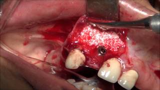 Extraction & Immidiate Implant Placement Using Bone Graft & Membrane