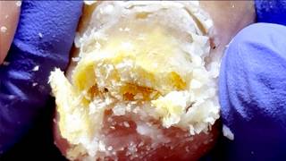 Wow, Super Thick Onychomycosis Requires Careful Trimming!【 Xue Yidao】