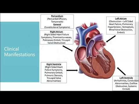 Mass Effect: Adult Primary Cardiac Tumors