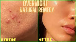 HOW TO GET RID OF ACNE, PIMPLES, BUMPS ON FACE OVERNIGHT | Simple Home Remedy (DIY Lemon Treatment)