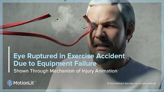 Exercise Equipment Failure leads to Ruptured Eye Surgery Portrayed Through Injury Animation