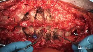Lab Demo: C7, T1, T2 Pedicle Screws - Charles Sansur, MD, MHSc