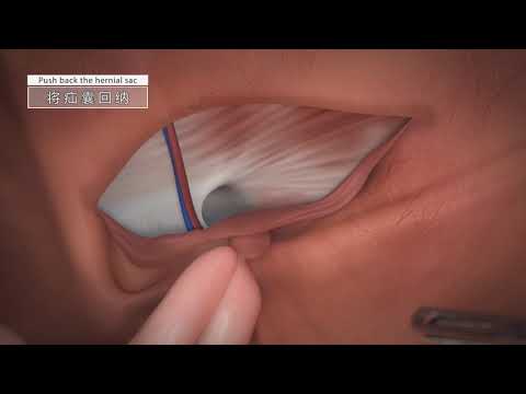 TAPP surgery Hernia repair by 3D mesh