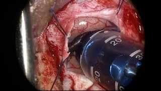 Access: Hemorrhagic Stroke