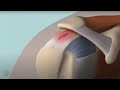 Learn About Rotator Cuff Damage