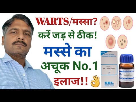मस्सा हटाने के उपाय | Warts Removal | Warts Homeopathy Medicine | Thuja Mother Tincture Uses