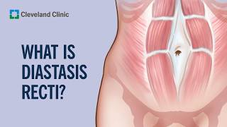 What Is Diastasis Recti And How to Check Yourself For it