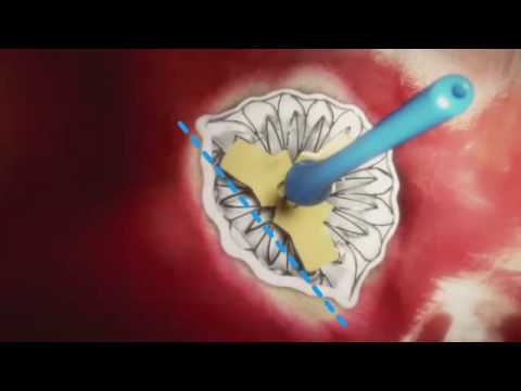 Transcatheter Mitral Valve Replacement (Neovasc)