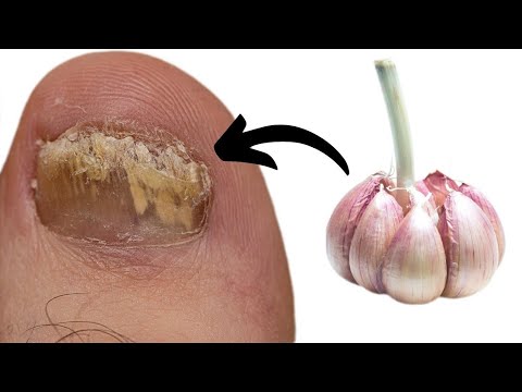 How GARLIC Remove FUNGAL FOOT INFECTION?