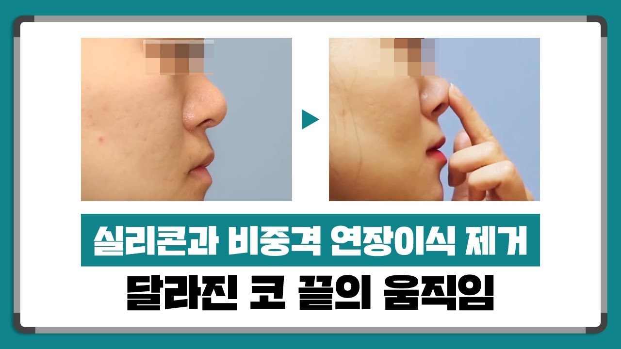 코보형물(메드포어)제거 사례 썸네일