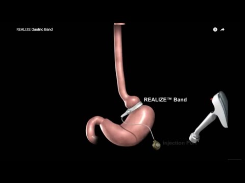  Gastric Band Demonstration Copied From You Tube for demo purposes only