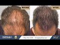 Scalp Micropigmentation (SMP) is another popular solution for hair loss.