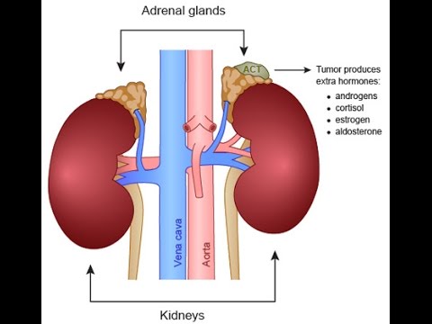 Primary Aldosteronism - YouTube