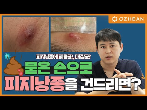 피지낭종에서 대장균이 발견됬다고? 피지낭종 표피낭종 함부로 짜면 안돼요!