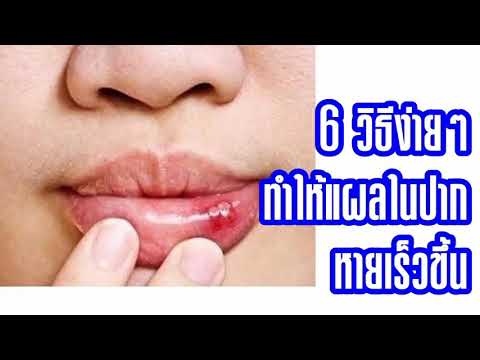 วิธีการเอาชนะโรคสะเก็ดเงิน ครีมสำหรับกลากและโรคสะเก็ดเงิน