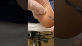 Download lagu Expert Australian Podiatrist Removes Painful Corns with Precision mp3 Download lagu Expert Australian Podiatrist Removes Painful Corns with Precision mp3