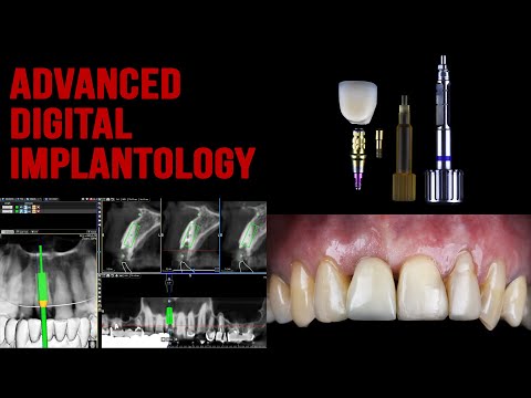 Dental Surgery - Socket shield - Connect system