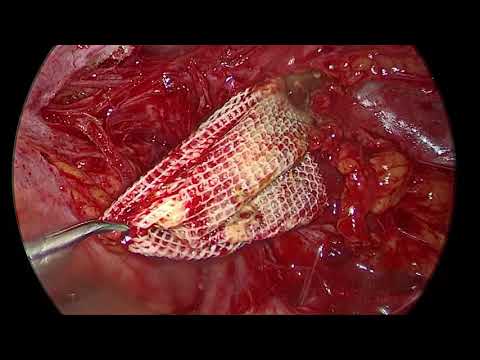 Dead Fish in Marshy Pond | Infected Mesh removal surgery