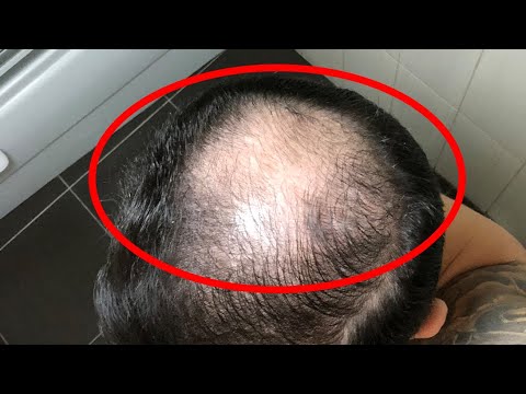 Kahle stelle am Kopf? Mit Streuhaar bekommst du sie weg! | Kniescheibe