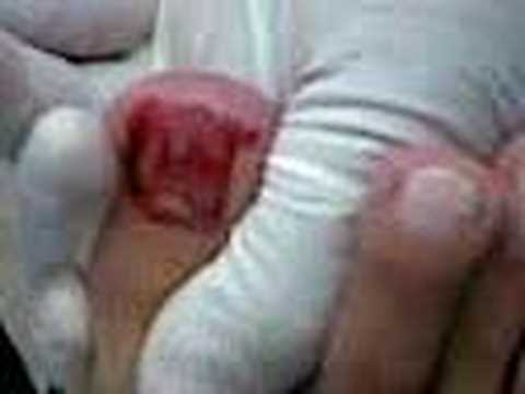 La aplicación de la tintura del propóleos al hongo de las uñas Si es posible hacer el gel el barniz sobre las uñas con el hongo